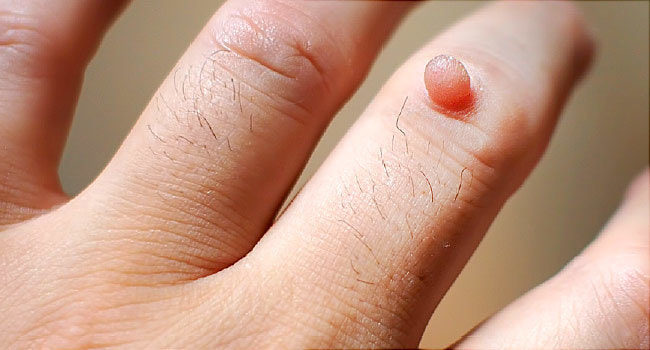 Homeopathy Treatment for Warts