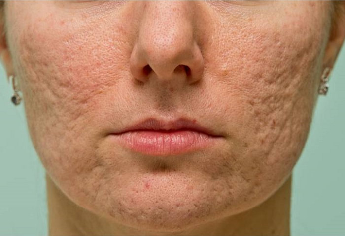 Homeopathy Treatment for Acne Scars
