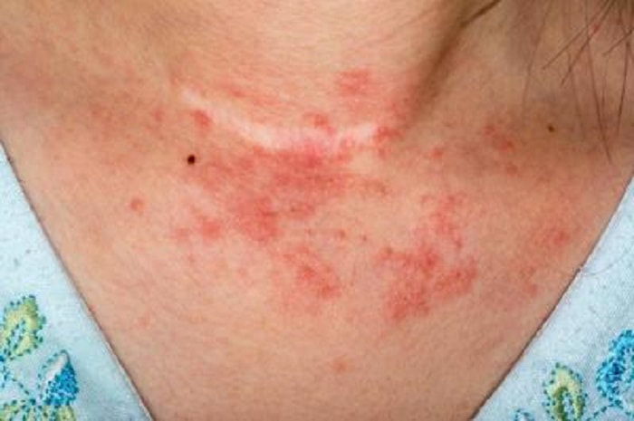 Homeopathy Treatment of Eczema