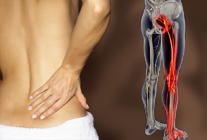 Homeopathy Treatment for Sciatica